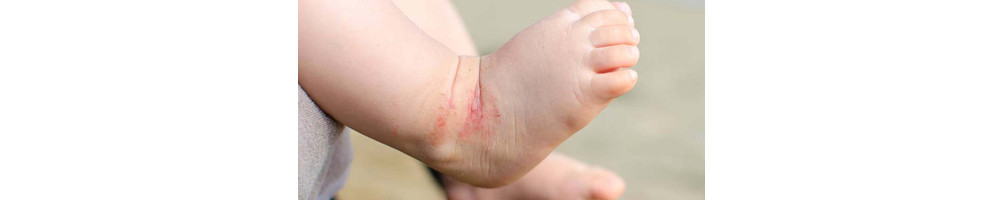 Cremas para piel atópica para niños | Gel para piel atópica niños